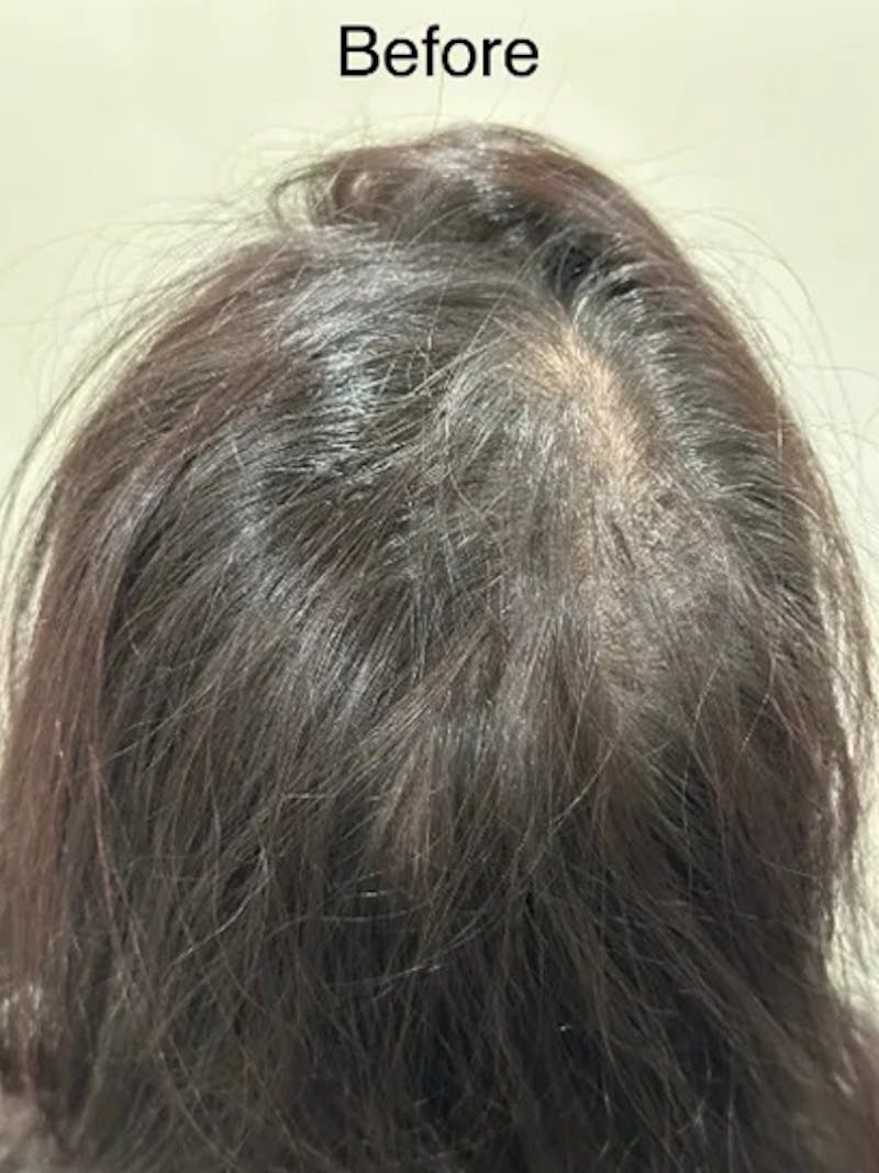 Scalp Micropigmentation Procedures Before & After Gallery - Patient 345746 - Image 1