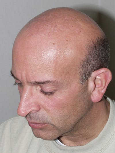 Hair Restoration for Men Before & After Gallery - Patient 293984 - Image 2