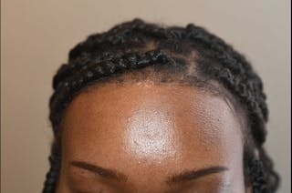 Hairline Lowering Surgery Before & After Gallery - Patient 198828 - Image 2