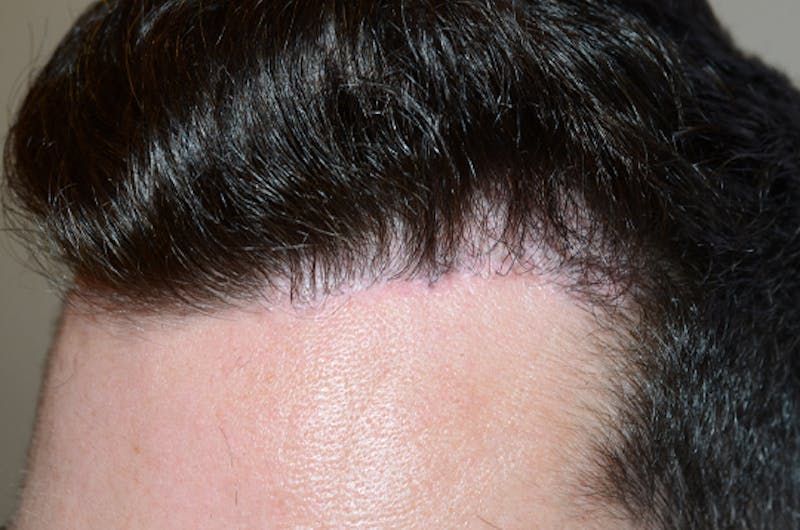 Hair Transplant Repair Before & After Gallery - Patient 151836 - Image 2