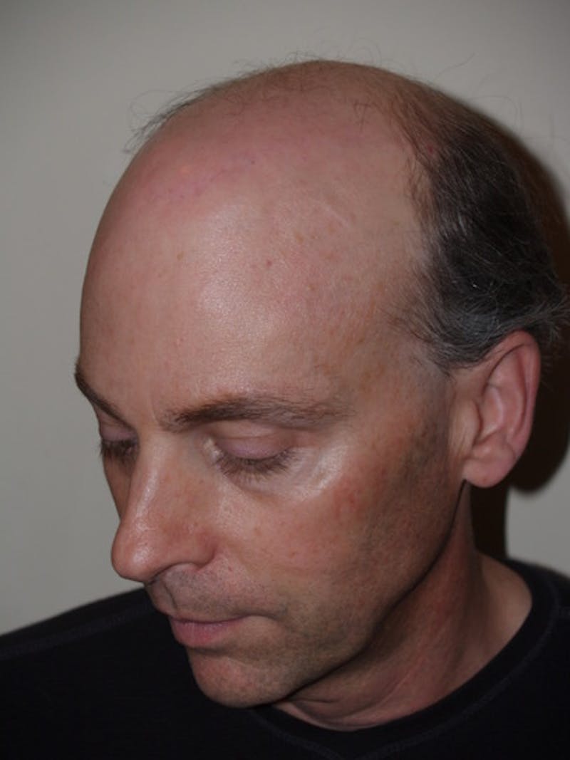 Special Cases Before & After Gallery - Patient 255551 - Image 4