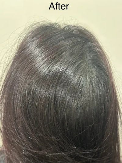 SMP Procedures Before & After Gallery - Patient 248527 - Image 2