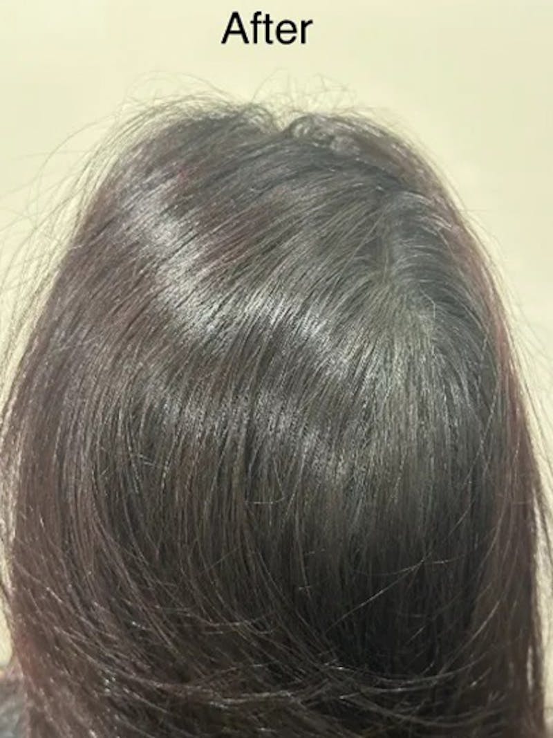 Scalp Micropigmentation Procedures Before & After Gallery - Patient 345746 - Image 2