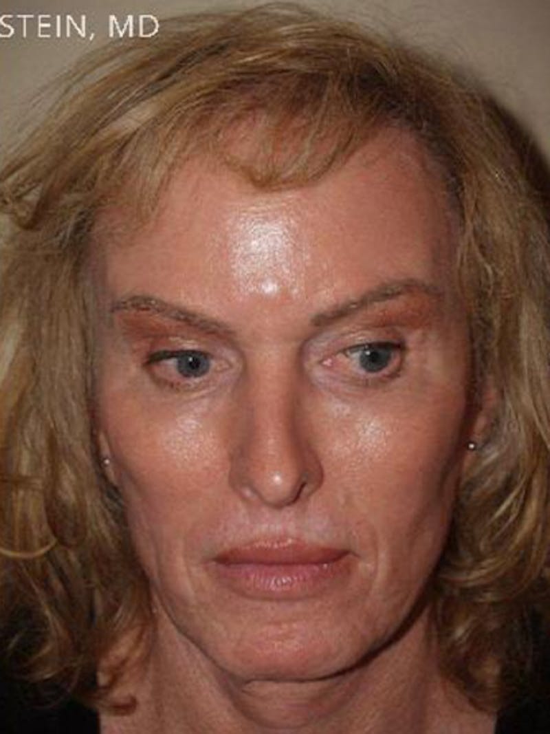 Special Cases Before & After Gallery - Patient 145966 - Image 2