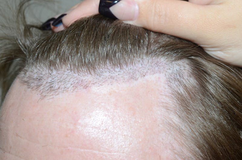 Hair Restoration for Men Before & After Gallery - Patient 210725 - Image 3