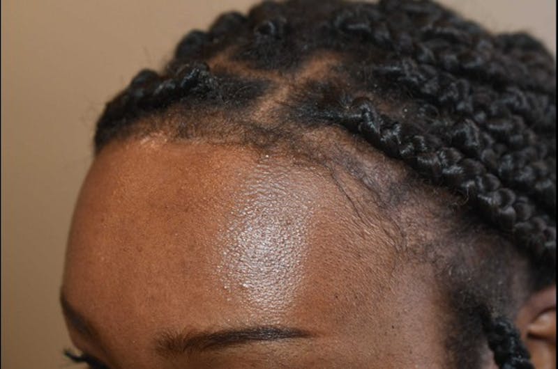 Hairline Lowering Surgery Before & After Gallery - Patient 209152 - Image 4