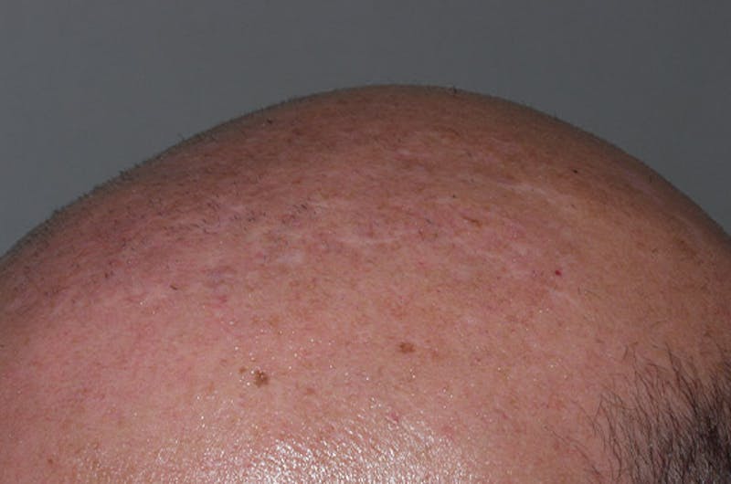 Hair Restoration for Men Before & After Gallery - Patient 906924 - Image 4