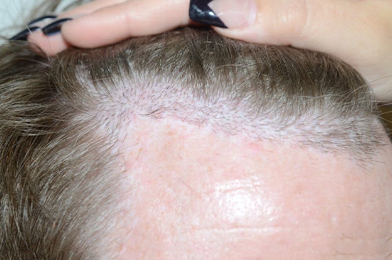 Hair Restoration for Men Before & After Gallery - Patient 210725 - Image 5