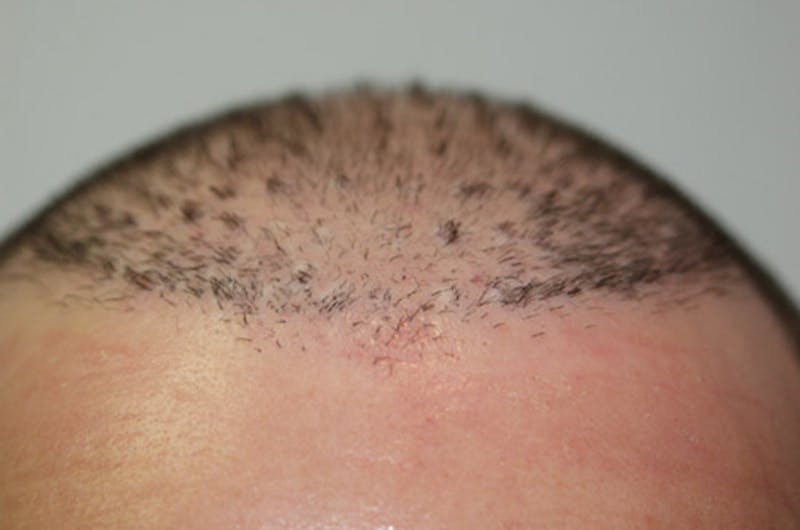 Hair Restoration for Men Before & After Gallery - Patient 175435 - Image 1