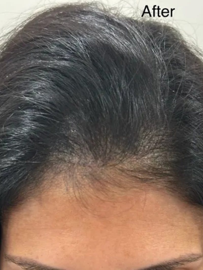 Scalp Micropigmentation Procedures Before & After Gallery - Patient 345746 - Image 4