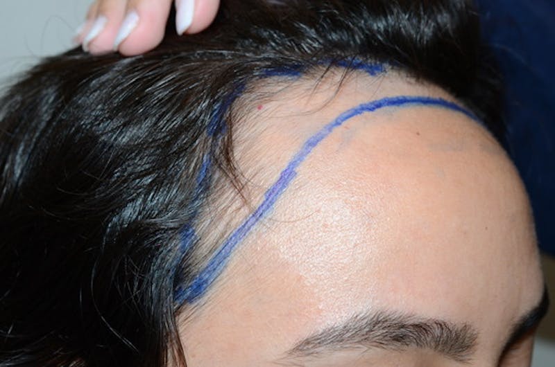 Hair Procedures for Women Before & After Gallery - Patient 144295 - Image 5