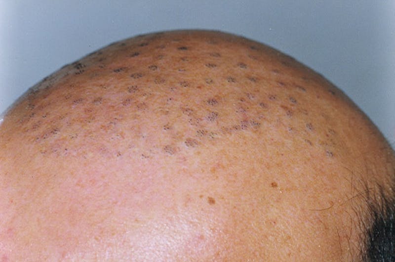 Hair Restoration for Men Before & After Gallery - Patient 906924 - Image 3
