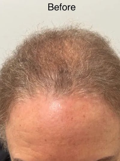 SMP Procedures Before & After Gallery - Patient 261460 - Image 1