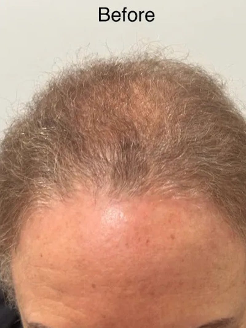 Scalp Micropigmentation Procedures Before & After Gallery - Patient 246005 - Image 1