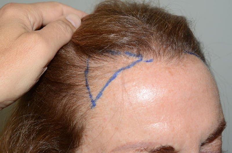 Hair Procedures for Women Before & After Gallery - Patient 361500 - Image 3
