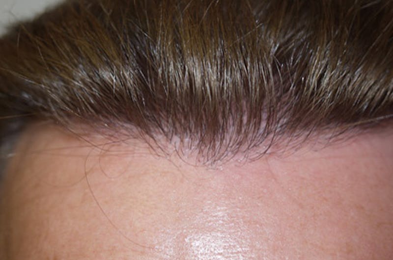 Hair Restoration for Men Before & After Gallery - Patient 175435 - Image 2