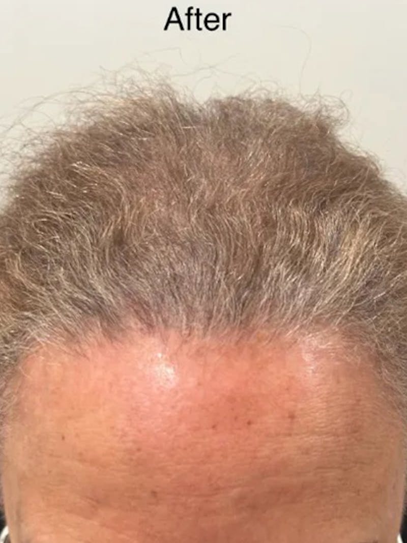 Scalp Micropigmentation Procedures Before & After Gallery - Patient 246005 - Image 2