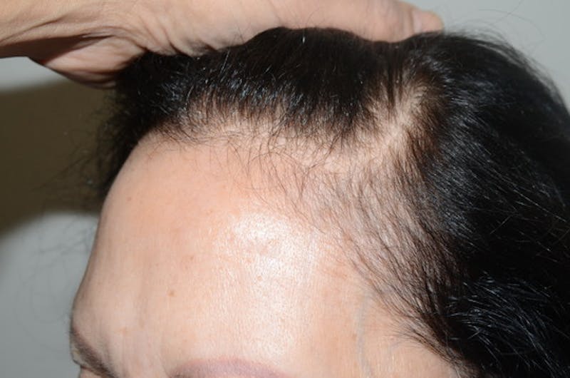 Hair Procedures for Women Before & After Gallery - Patient 381295 - Image 3