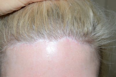 Hair Procedures for Women Before & After Gallery - Patient 395314 - Image 1