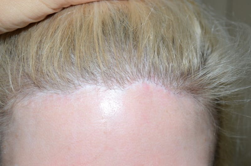 Special Cases Before & After Gallery - Patient 138476 - Image 1