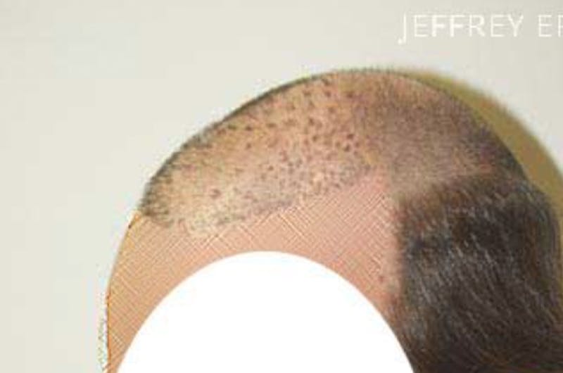 Hair Restoration for Men Before & After Gallery - Patient 175435 - Image 3