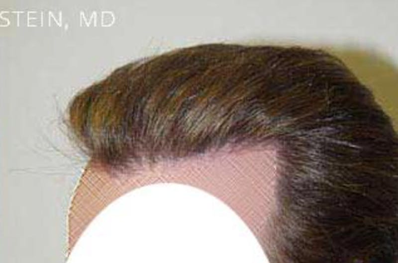 Hair Restoration for Men Before & After Gallery - Patient 175435 - Image 4