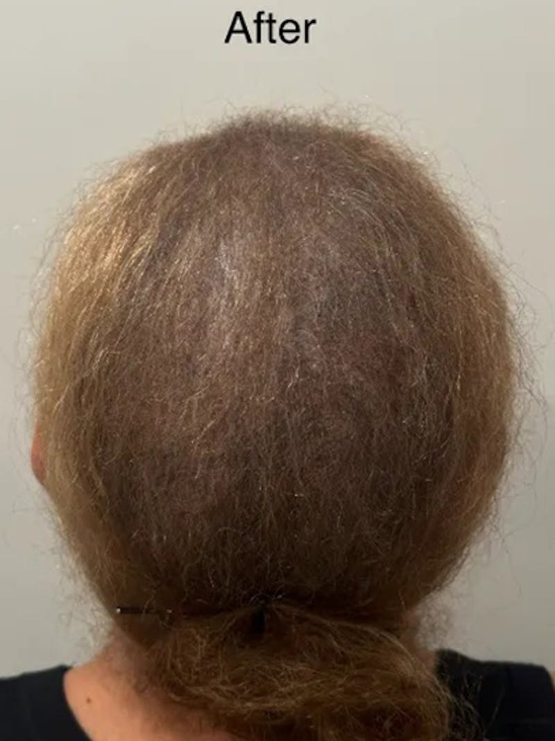 Scalp Micropigmentation Procedures Before & After Gallery - Patient 246005 - Image 4