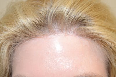 Hair Procedures for Women Before & After Gallery - Patient 395314 - Image 2