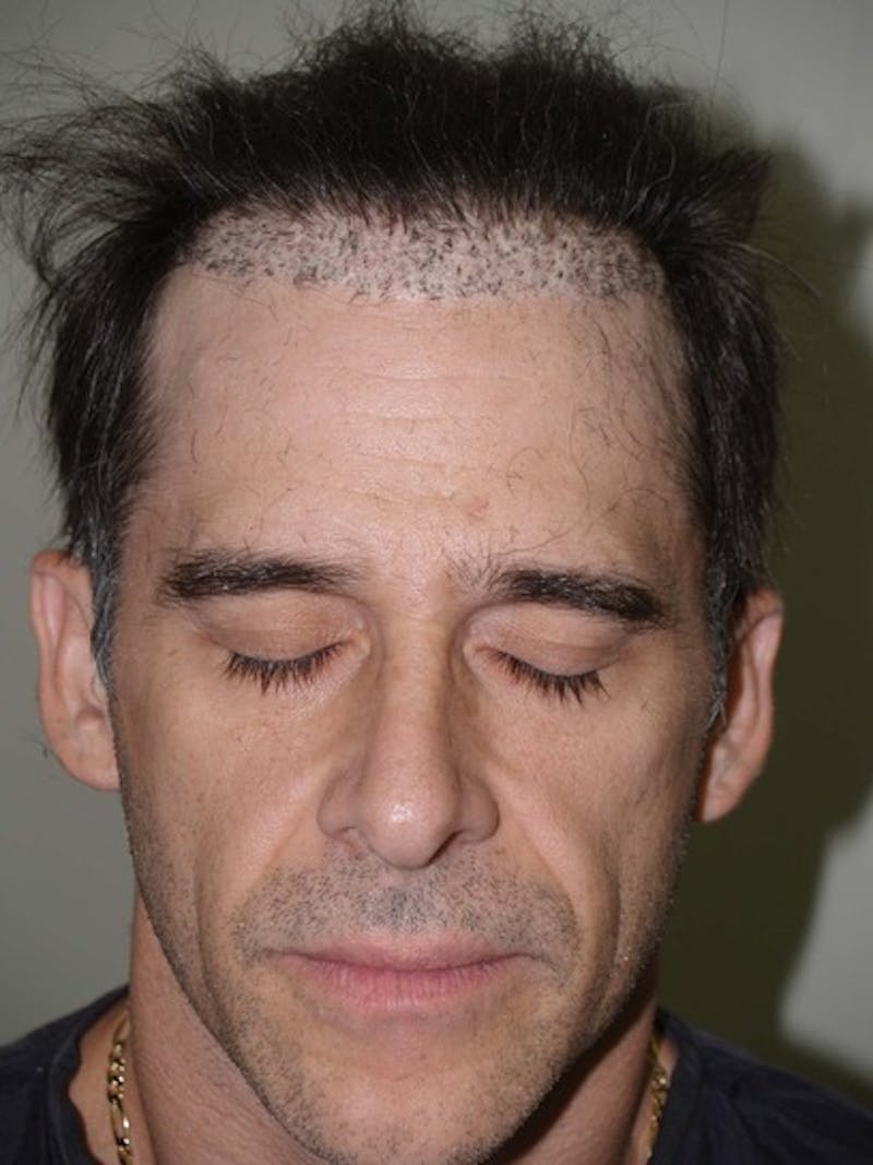 Hair Restoration for Men Before & After Gallery - Patient 825232 - Image 1