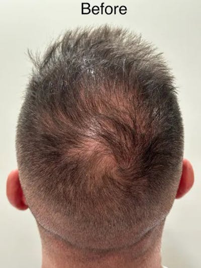 SMP Procedures Before & After Gallery - Patient 112067 - Image 1