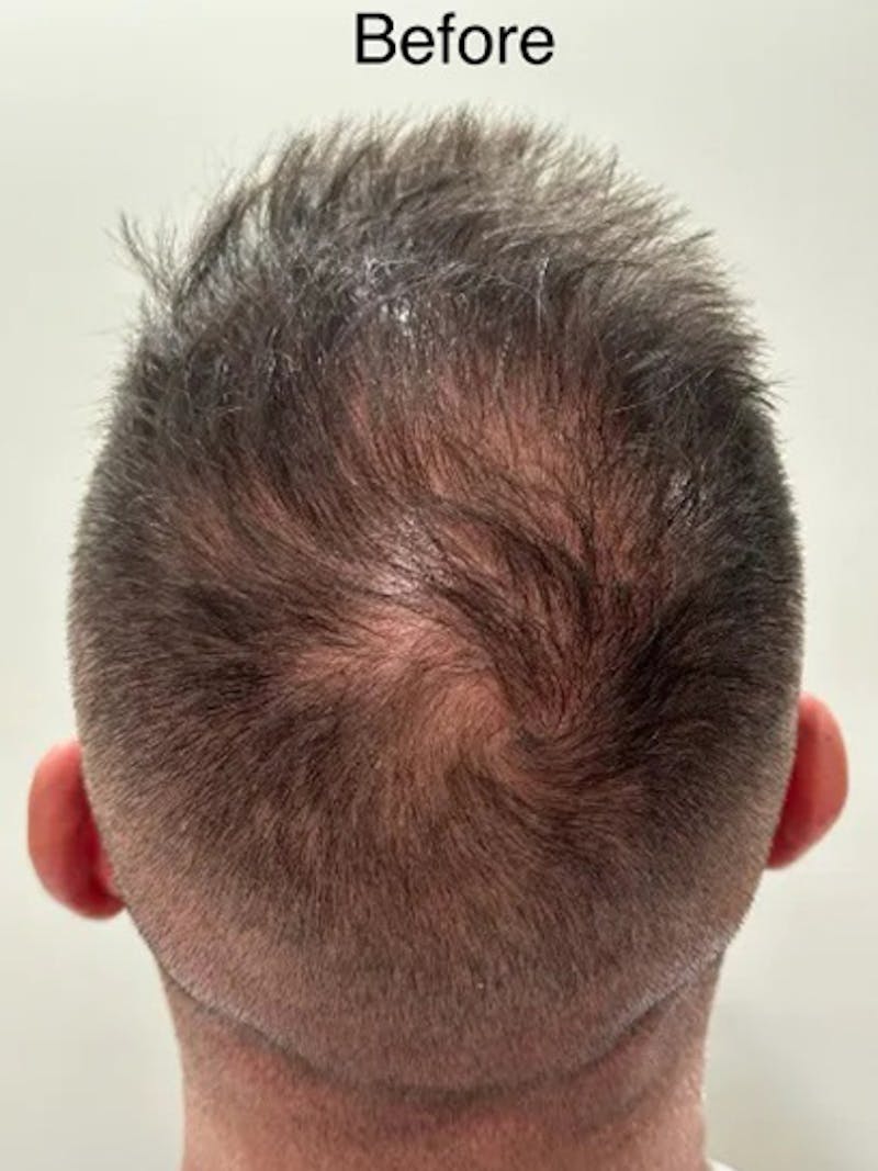 Scalp Micropigmentation Procedures Before & After Gallery - Patient 199053 - Image 1