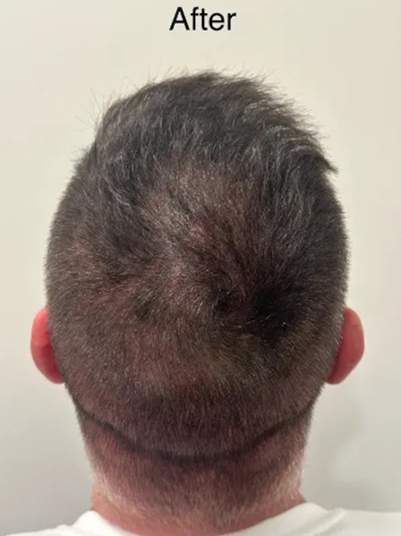 Scalp Micropigmentation Procedures Before & After Gallery - Patient 199053 - Image 2