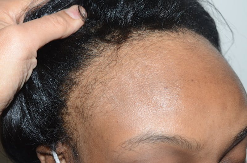 Hair Procedures for Women Before & After Gallery - Patient 389169 - Image 5