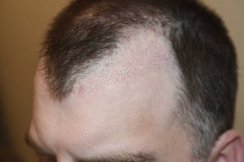 Hair Restoration for Men Before & After Gallery - Patient 383804 - Image 1