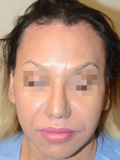 Hair For Gender Reaffirmation Before & After Gallery - Patient 364078 - Image 1