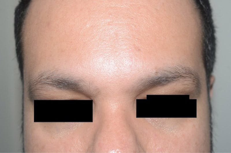 Eyebrow Transplantation Before & After Gallery - Patient 275303 - Image 1