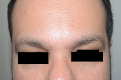 Eyebrow Transplantation Before & After Gallery - Patient 561023 - Image 1