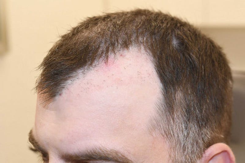 Hair Restoration for Men Before & After Gallery - Patient 383804 - Image 2