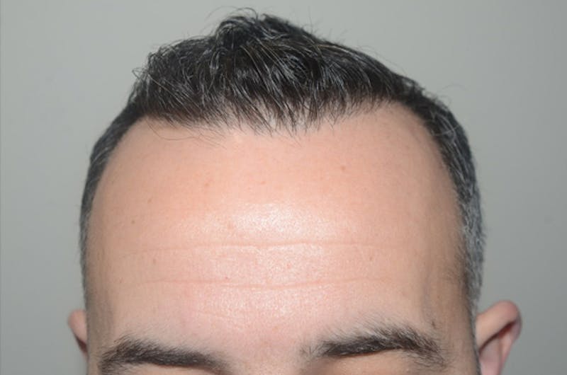 Hair Restoration for Men Before & After Gallery - Patient 162049 - Image 1
