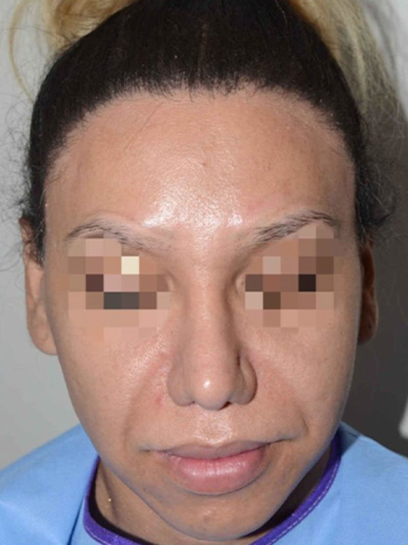 Special Cases Before & After Gallery - Patient 151257 - Image 2