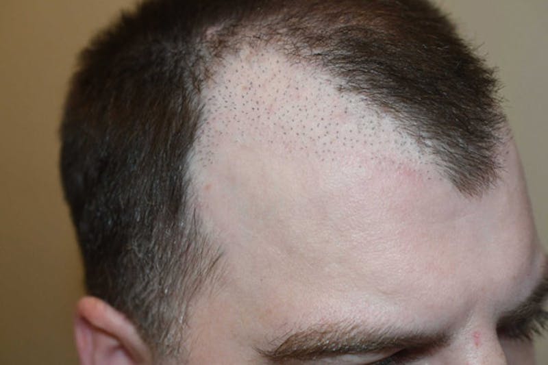Hair Restoration for Men Before & After Gallery - Patient 383804 - Image 3