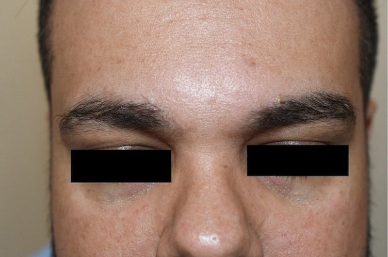 Eyebrow Transplantation Before & After Gallery - Patient 275303 - Image 2