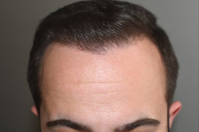 Hair Restoration for Men Before & After Gallery - Patient 162049 - Image 2
