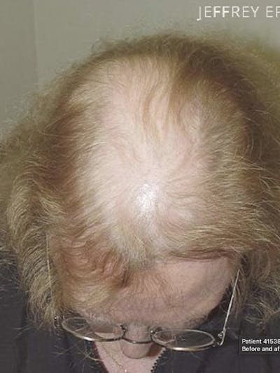 Hair Procedures for Women Before & After Gallery - Patient 160375 - Image 1