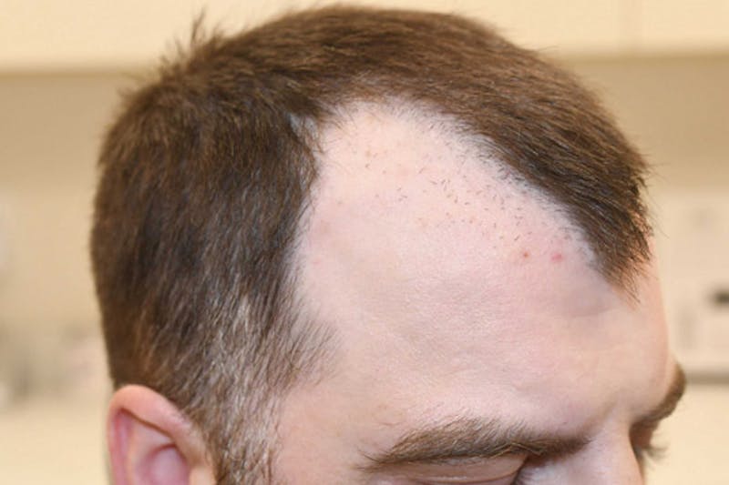 Hair Restoration for Men Before & After Gallery - Patient 383804 - Image 4