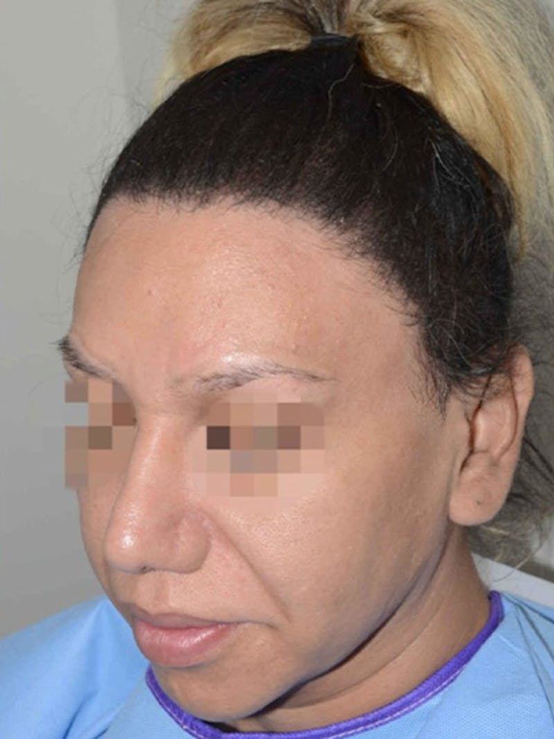 Special Cases Before & After Gallery - Patient 151257 - Image 4