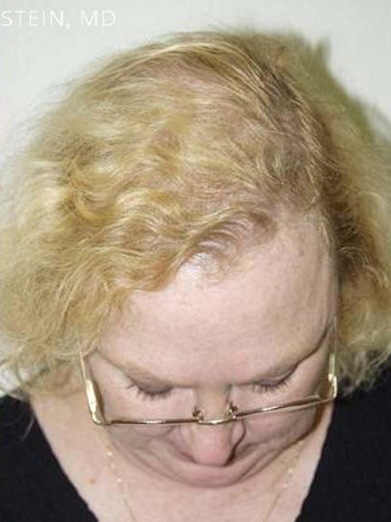 Hair Procedures for Women Before & After Gallery - Patient 397422 - Image 2