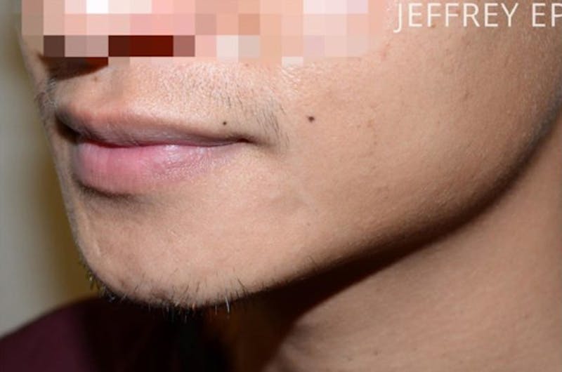 Facial Hair Transplant Before & After Gallery - Patient 294368 - Image 1
