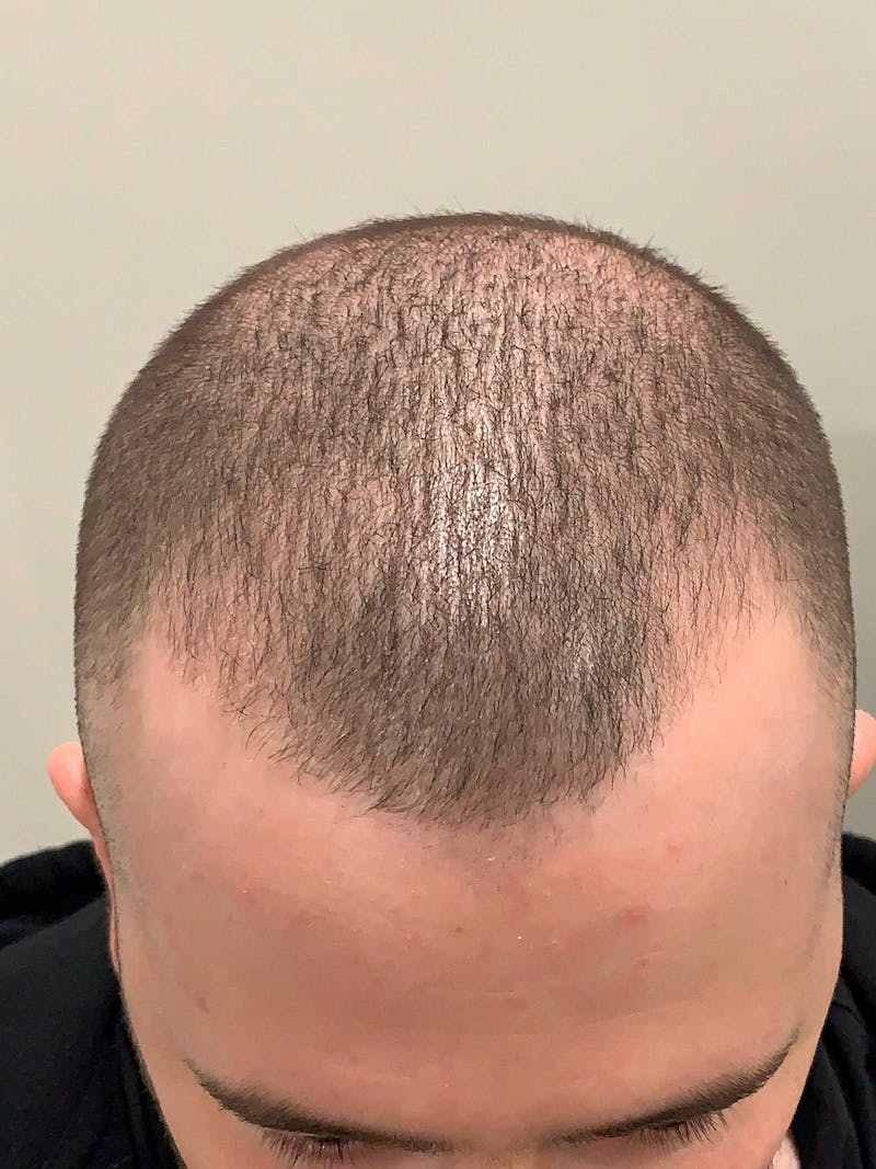 Scalp Micropigmentation Procedures Before & After Gallery - Patient 261665 - Image 1