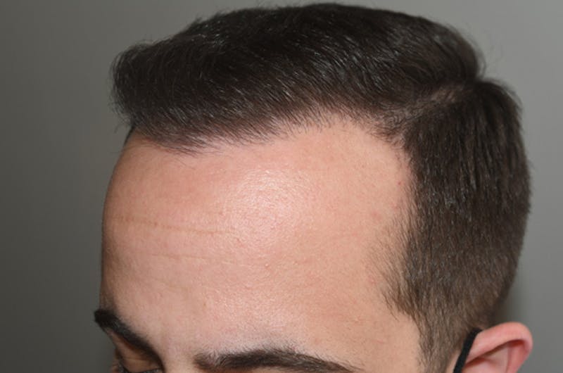 Hair Restoration for Men Before & After Gallery - Patient 162049 - Image 4